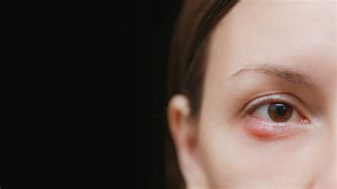 眼肿是什么原因引起的 - 专家文章 - 复禾健康