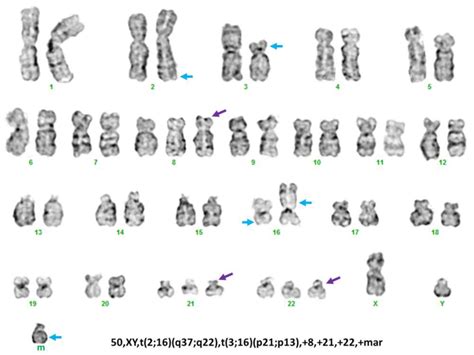 PPP1R7 Is a Novel Translocation Partner of CBFB via t(2;16)(q37;q22) in ...