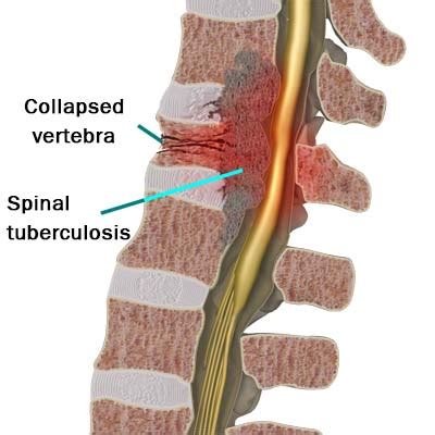Dr Nilesh Zope - Spine Specialist Doctor in Kalyan & Dombivli | Spine ...