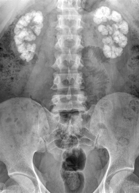 Medullary Sponge Kidney Nephrocalcinosis Ultrasound at Bobby Haley blog