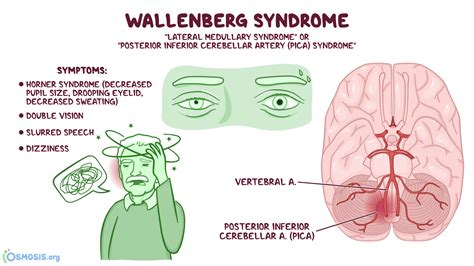 Wallenberg syndrome powerpoint pica syndrome powerpoint - szlery