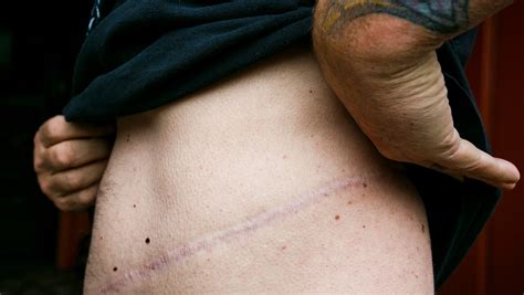 Kidney Transplant Donor Scar