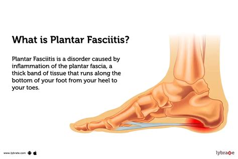 Plantar Fasciitis 的图像结果