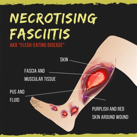Necrotizing fasciitis (NF), also known as flesh-eating disease, is a bacterial infection that ...