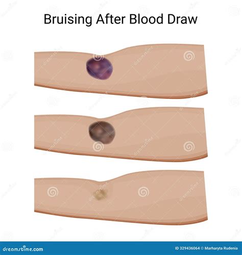Bruise Stages Diagram Medical Science Vector Illustration ...