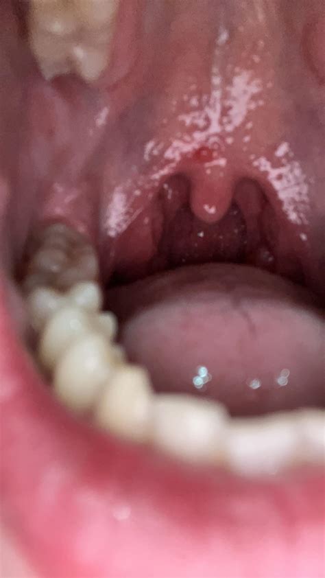 Red Pimples On Throat