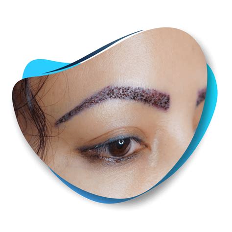 Eyebrow Transplant - Capital Hair Transplant Turkey Dr. Ekrem Keskin