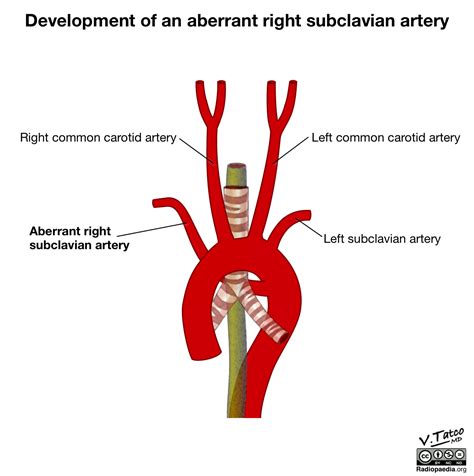 Radiopaedia - Drawing Aberrant right subclavian artery - English labels ...