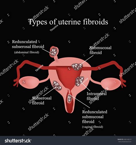 Types Of Uterine Masses at Kaitlyn Joseland blog