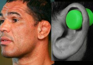Bildergebnis für cauliflower ear before and after