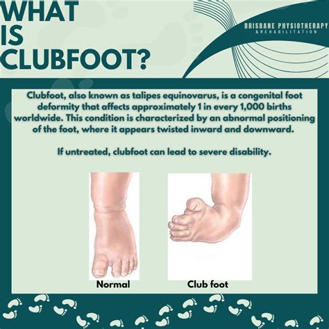What Is Clubfoot Treatments And Symptoms Facty Health What Are The 5