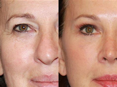 Eyelid Surgery - Upper & Lower, Blepharoplasty Surgery, Recovery