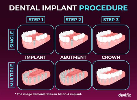 Dental Implant Procedure: Step-by-Step into Sessions - Dentfix