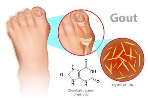 Gout Treatment & Symptoms Podiatrist near me- Beaver Valley Foot Clinic