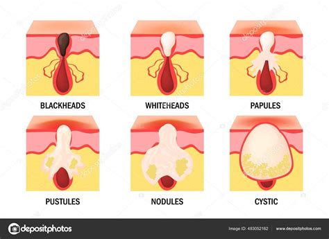 Nodule Vs Cyst Pimple