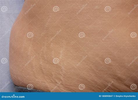 Postnatal Changes As Stretches on Skin. after Birth Marks on Belly of ...