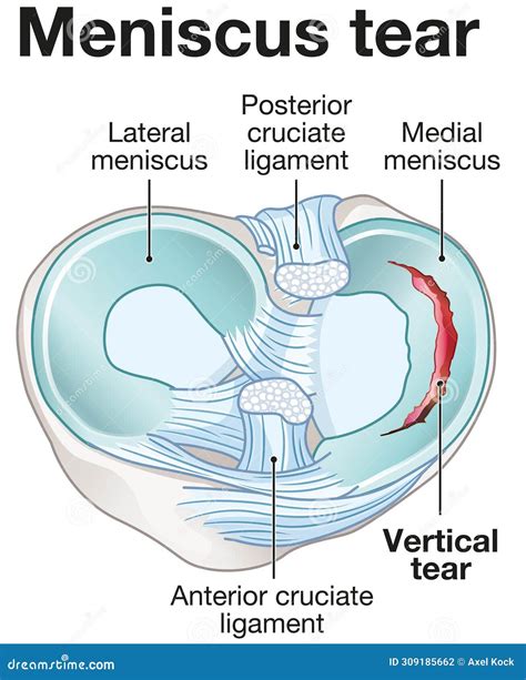 Meniscus Education | Education Center