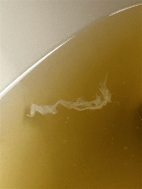 Kidneys and urine : r/KidneyStones