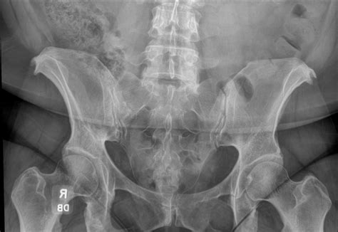 Sacrum X Ray Angle at Cynthia Jasmin blog
