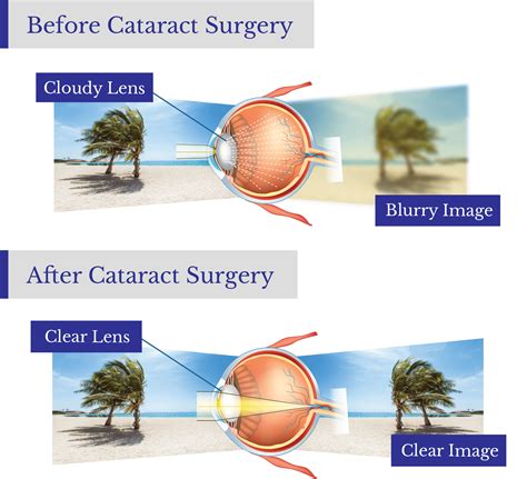 Japanese Lens For Cataract at Lee Porter blog