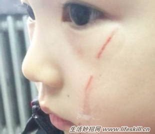 孩子被猫抓伤了，如何消除抓伤疤痕？ - 生活妙招网
