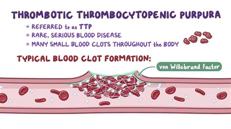 Thrombocytopenic Purpura