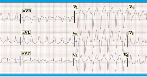 Image result for AFib Detection Algorithm