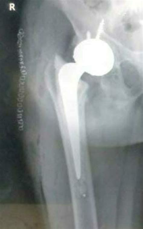 Challenging Hip Replacement Surgery by Dr. Kiran Kharat, Hip ...