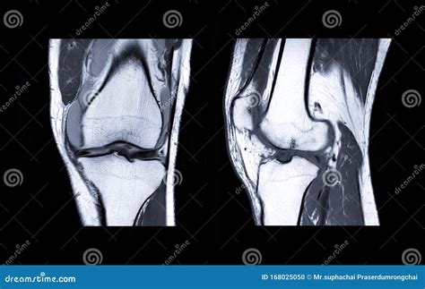 Coronal PD FS MRI Of Knee Royalty-Free Stock Photography ...