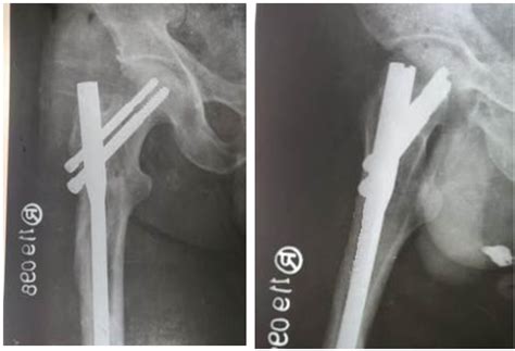 Comparative study of Ender’s nailing and PFN in subtrochanteric ...