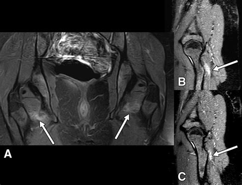Obturator Externus Mri