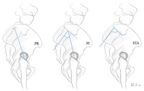 Changes of Fixed Anatomical Spinopelvic Parameter in Patients with ...