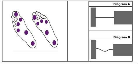 Diabetic Neuropathy Detection Devices - DFCIPL Medical Monofilaments ...