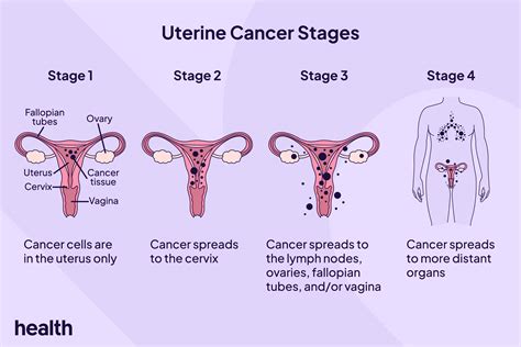 Stages Of Uterine Cancer Chart