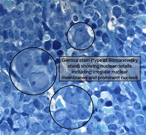Morphologic features of Acute Lymphoblastic Leukemia (B-ALL) involving ...