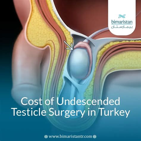 Cost of undescended testicle surgery in Turkey: Guide