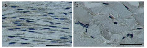 HtrA1 Is Specifically Up-Regulated in Active Keloid Lesions and ...