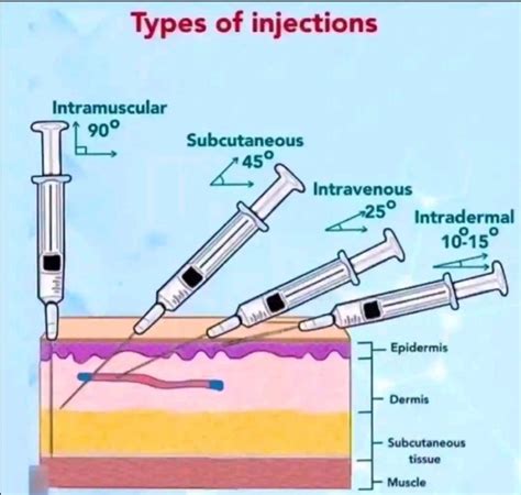 Here's a detailed overview of injection angles and types 🎯: Injection ...