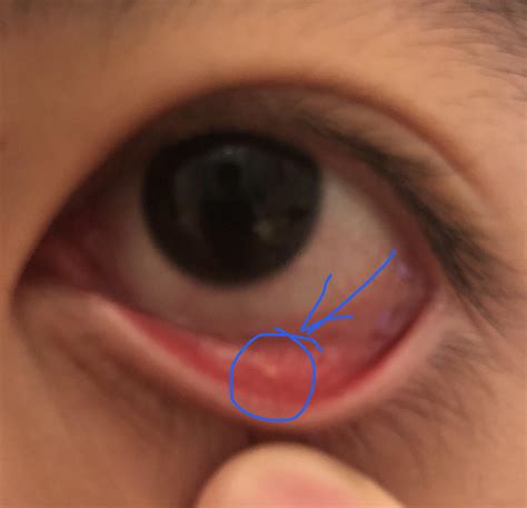 Spots Under The Eyelid