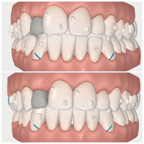 Image result for Invisalign ClinCheck