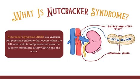 renal nutcracker syndrome presentation ET | PDF
