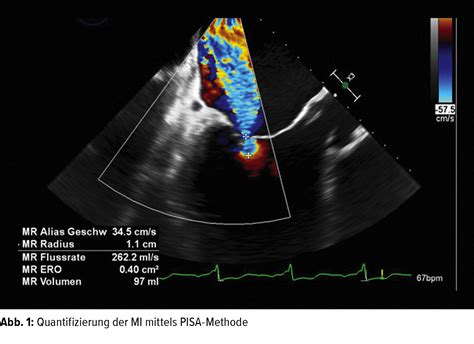 Stellenwert der Echokardiografie beim MitraClip®-Verfahren ...