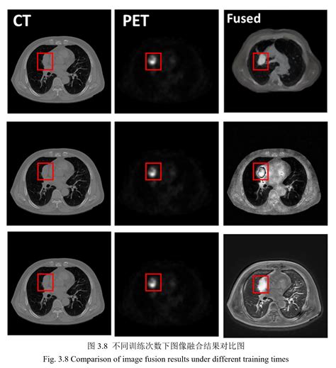 论文阅读：基于深度学习的肺肿瘤PET-CT图像融合-CSDN博客