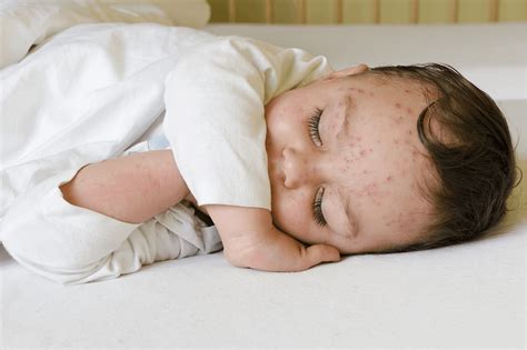 Infant vaccination | Shingles disease & prevention | GSK protect