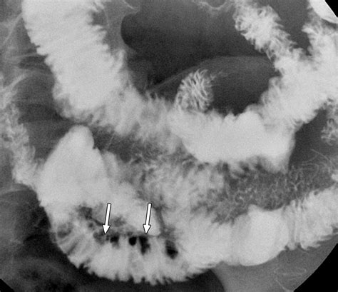 A Pattern Approach to the Abnormal Small Bowel: Observations at MDCT ...