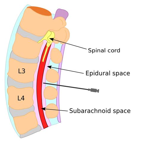 Epidurals | Pain Management