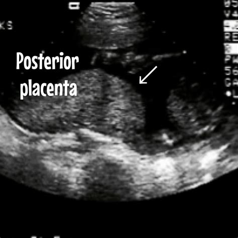 Everything about the placenta. Ultrasound included. - Ultrasoundfeminsider