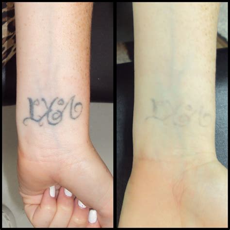 Laser Tattoo Removal Scars