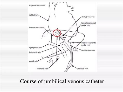 Neonatal Umbilical Venous Catherization Radiology | PPT