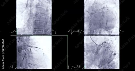 Coronary Angiogram Procedure 的图像结果